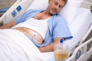 Kidney transplant recipient lying in hospital bed with surgical drain tube and drainage bag containing straw colored fluid after transplant surgery