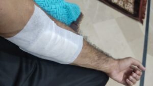 Bandaged left arm after AV fistula closure surgery in kidney transplant patient