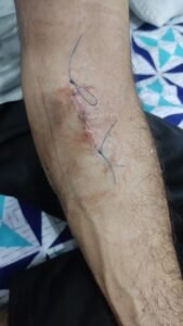 Healing stitches after AV fistula ligation surgery during early recovery phase