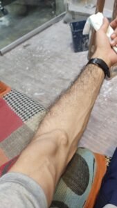 Enlarged upper arm AV fistula with swollen veins before fistula closure surgery in a kidney transplant recipient